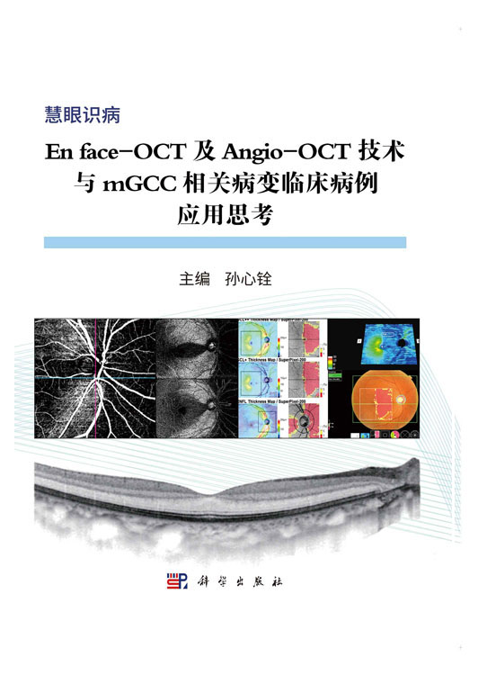 En face-OCT及Angio-OCT技术与mGCC相关病变临床病变应用思考